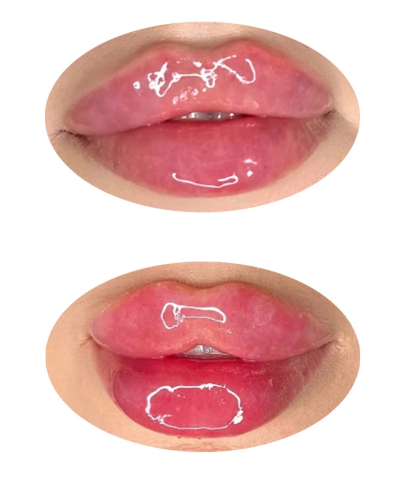 Lip Injection (syringe)
